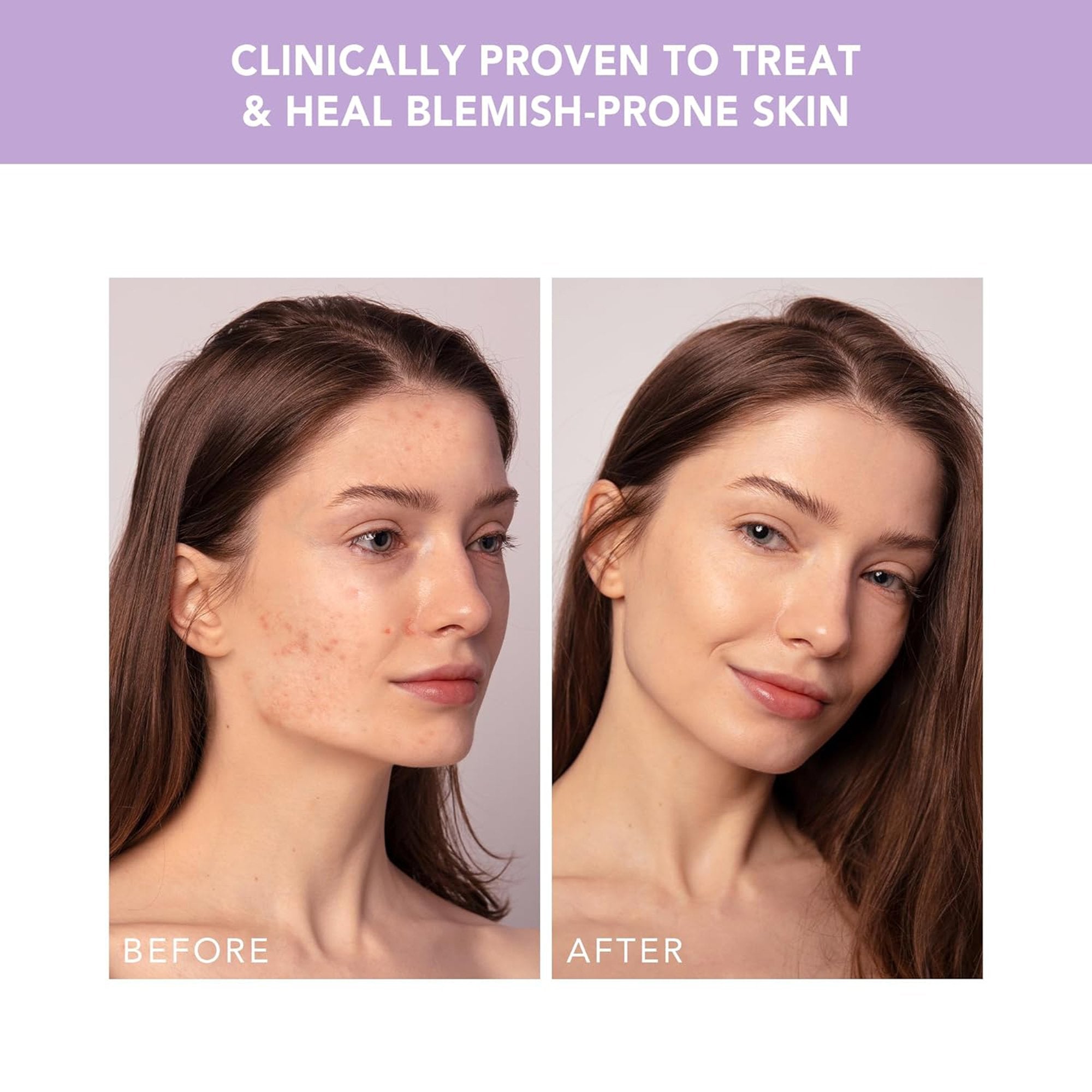 ESPADA™ 2 Plus Acne Therapy Device, Lavender F1757